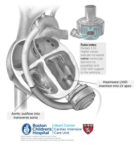 centrifugal heart pump|heartmate 3 pump.